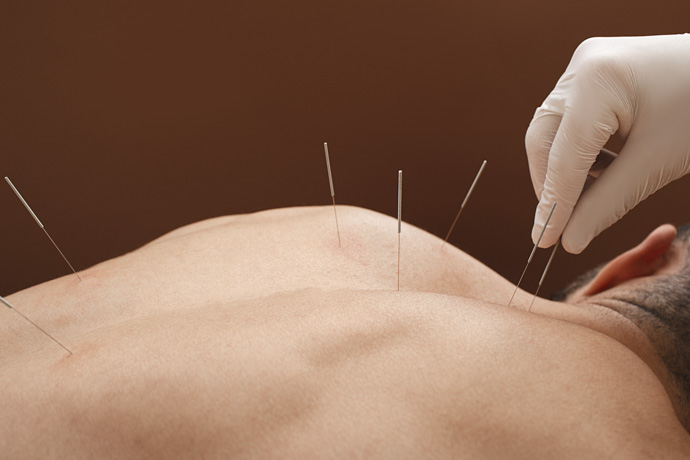 hombre en sesión de acupuntura