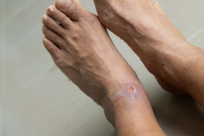 Persona con ampollas en las piernas