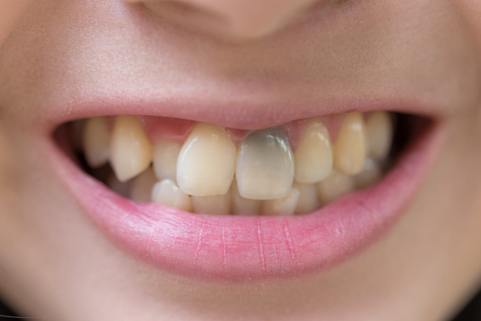 Persona con pérdida de esmalte dental y caries