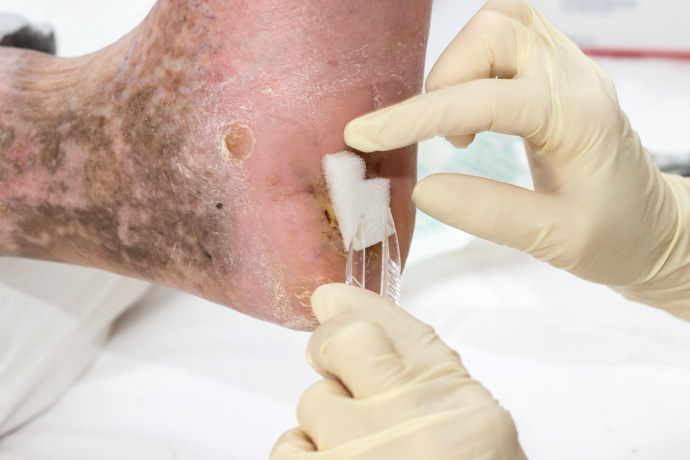 persona sufre de pie diabético