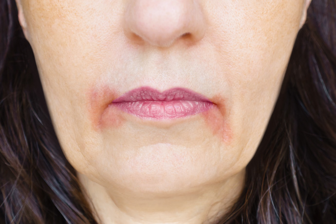 mujer con boqueras o queilitis angular