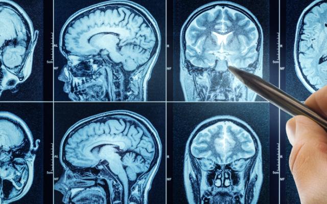 Escáner de cerebro que muestra el síndrome de Wernicke-Korsakoff.
