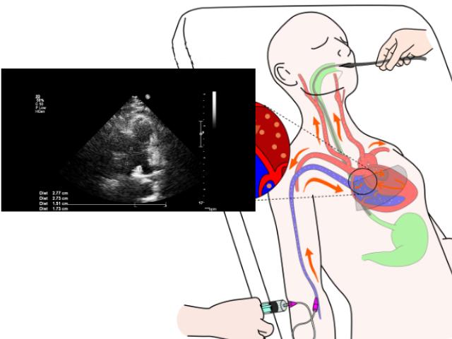 Diagrama de un ecocardiograma transesofágico aplicado a un paciente
