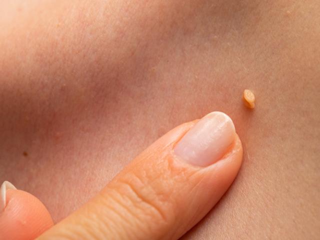 Persona que se pregunta cómo fortalecer el sistema inmunológico para eliminar el VPH.