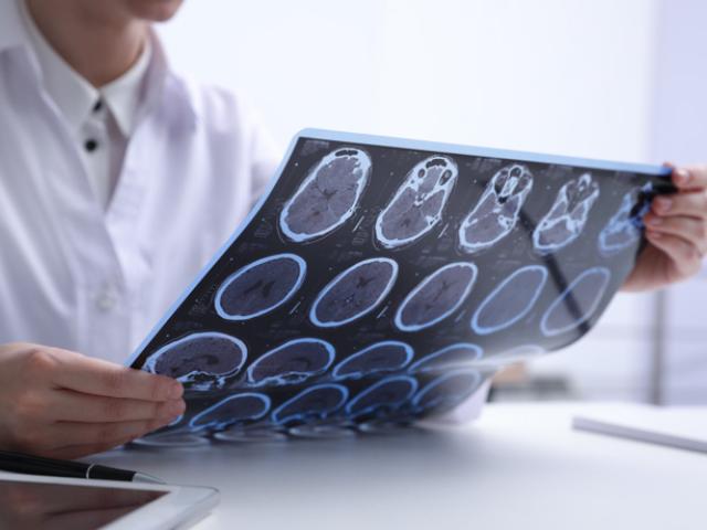 Médico analizando los avances de una esclerosis múltiple en un paciente.