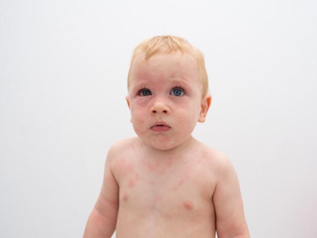 bebe con reaccion alergica
