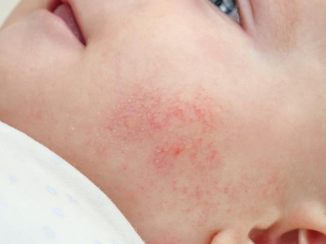 Bebé con dermatitis atópica